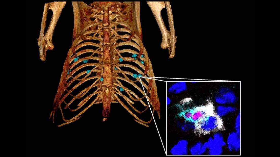 Lung cancer nodules imaged by micro-CT scanning. In these tumors, macrophages support regulatory T cells, which limit the efficacy of immunotherapy © De Palma's Lab / EPFL