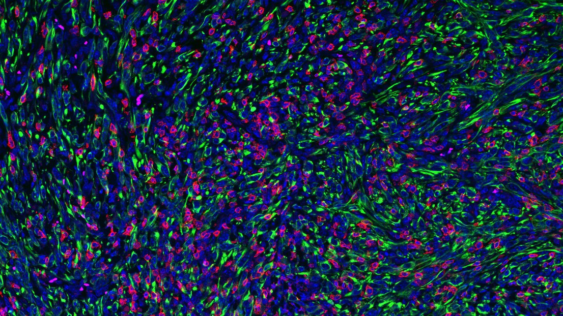 Tumor with FMRP-deficient cancer cells (in green) being infiltrated and attached by killer (CD8) T cells. Credit:  2022 EPFL/ Jeremy Guillot -Hanahan Lab- CC-BY-SA 4.0