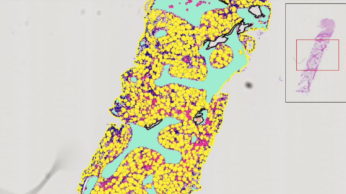 A screenshot of MarrowQuant annotating a bone marrow trephine biopsy from a patient surfing from chemotherapy-induced aplasia. Credit: Olaia Naveiras (EPFL) A screenshot of MarrowQuant annotating a bone marrow trephine biopsy from a patient surfing from chemotherapy-induced aplasia. Credit: Olaia Naveiras (EPFL)